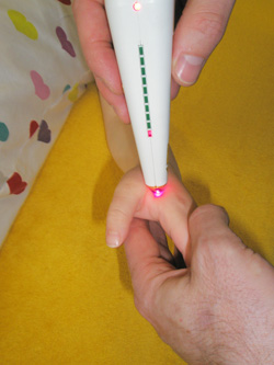Laserakupunktur